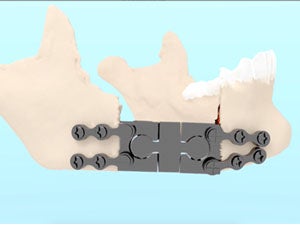 Modular endoprosthesis for mandible reconstruction
