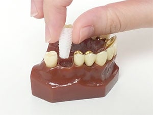 3D-Printed Dental Plug to Preserve Bone after a Tooth Extraction