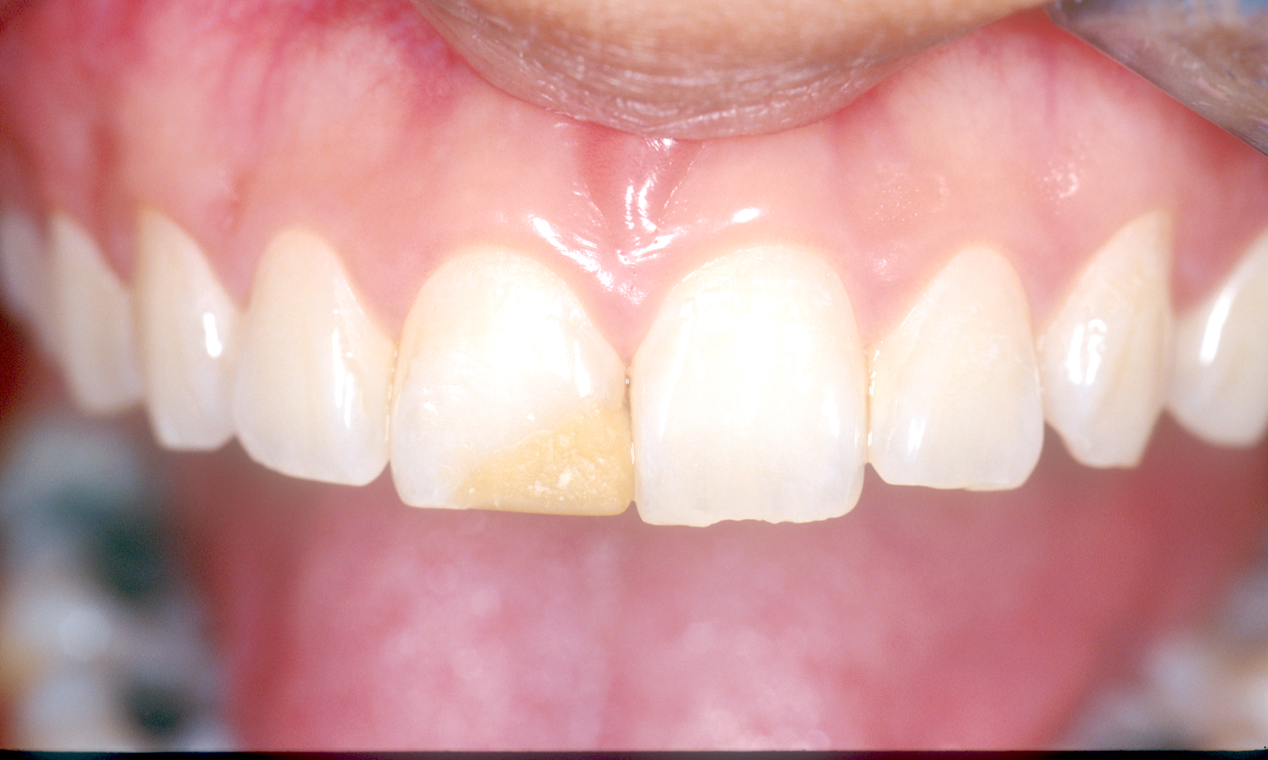 Crowns are used to correct problems in natural teeth by the National Dental Centre Singapore
