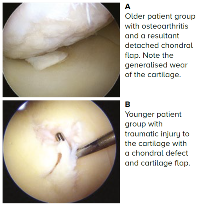 Arthroscopic pictures of chondral injuries in two different groups of patients - SingHealth Duke-NUS Cell Therapy Centre