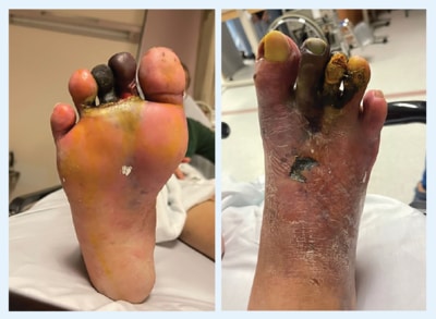 Wet gangrene on toes - SingHealth Duke-NUS Vascular Centre