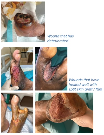 Wounds that have deteriorated and healed well - SingHealth Duke-NUS Vascular Centre