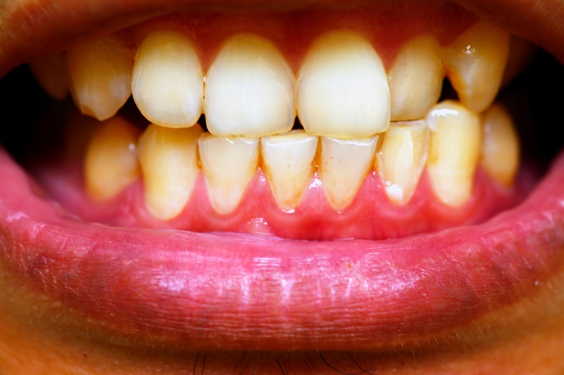 Gum disease can lead to loss of teeth and worsen other conditions, say experts
