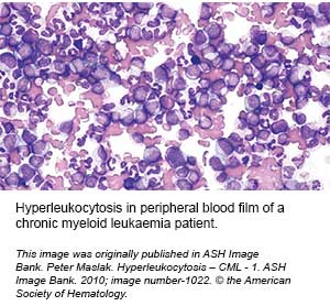 haematologic-emergencies-hyperleukocytosis-sgh-blood-cancer-centre