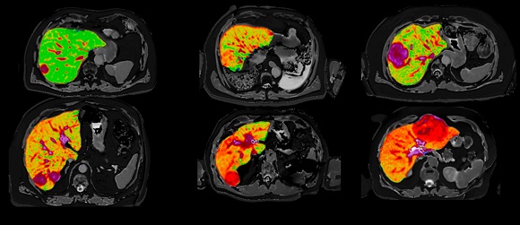  Quantitative MR images of the liver from six patients presenting with liver cancer produced by Perspectum’s LiverMultiScan which will be used in a new study led by National Cancer Centre Singapore.  

Image credit Mole DJ et al. Plos One. 2020;15(12)e0238568
