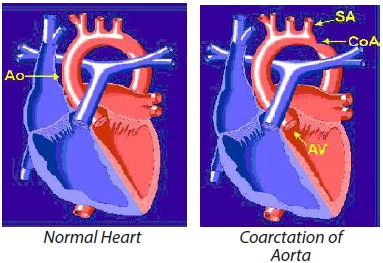 Coarctation of Aorta vs normal heart