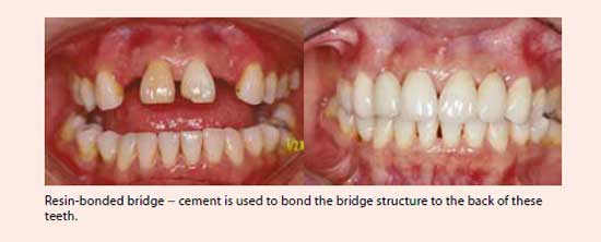 Resin-bonded bridge treatment at National Dental Centre Singapore