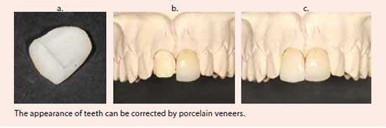 The appearance of teeth can be corrected by porcelain veneers - Veneers Treatment