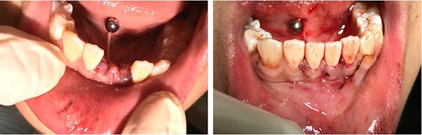 replantation after tooth avulsion