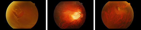 retinal tears conditions & treatments