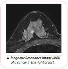 breast cancer diagnosis magnetic resonance imaging (MRI)