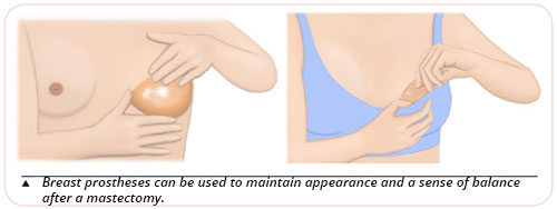 Breast cancer post-operative care - Physical appearance