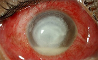 Corneal Infection due to bacteria- Eye Condition and Treatments SingHealth