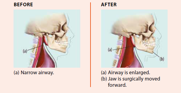 Enlarging of airway after jaw is surgically moved forward, National Dental Centre Singapore