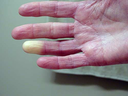 scleroderma (systemic sclerosis) is when the body’s immune system attacks its own tissues