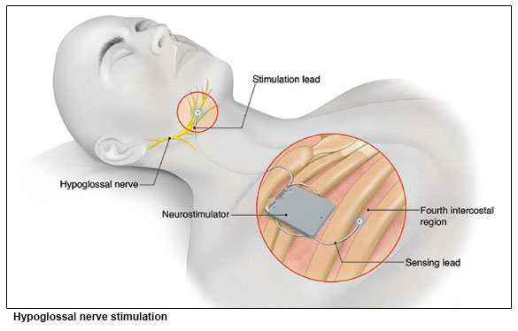 Hypoglossal nerve stimulation - Obstructive Sleep Apnoea (OSA) Conditions and Treatments